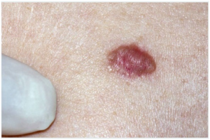 Dysplastic Nevus mole