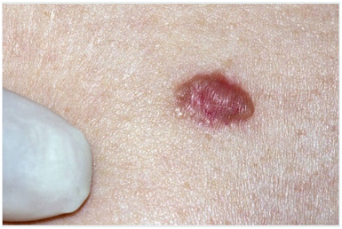 Dysplastic Nevus mole