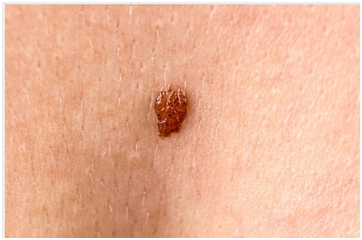 Spitz nevus mole