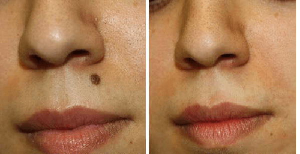 how to remove moles from face permanently