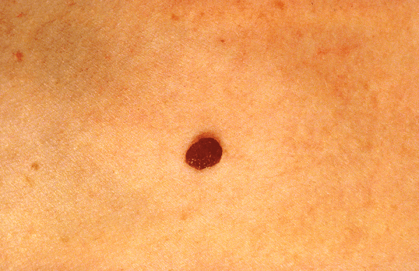 skin red moles