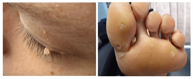 skin tags vs warts