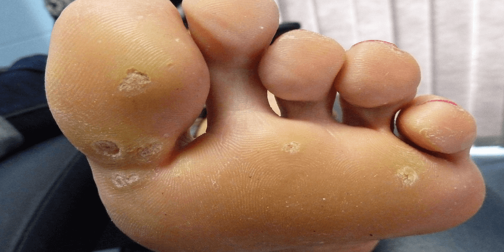 best foot wart removal