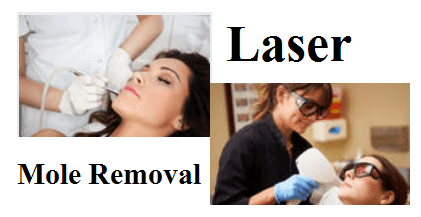 laser mole remover