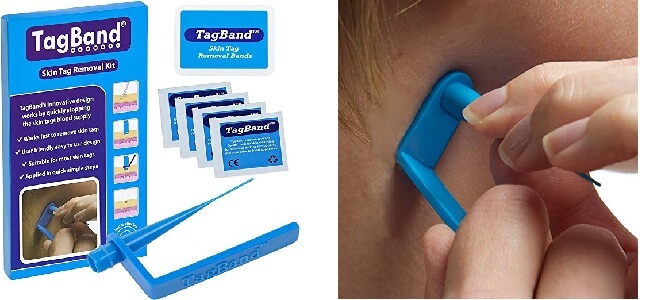 tagband skin tag removal device review