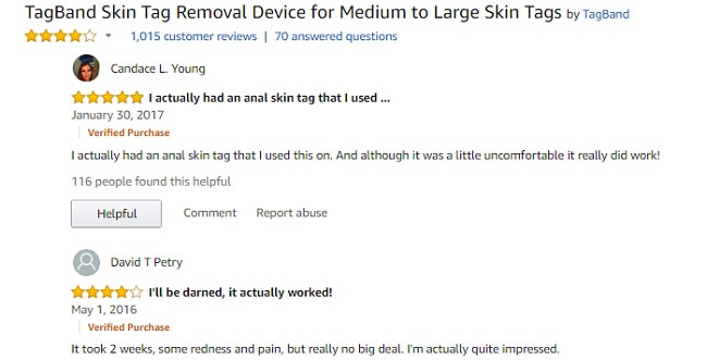 tagband skin tag removal device customer reviews