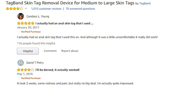 TagBand Skin Tag Removal Device Review Does It Work Really 